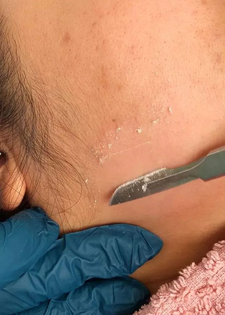 EXFOLIACIÓN AVANZADA (limpieza facial + dermaplaning)