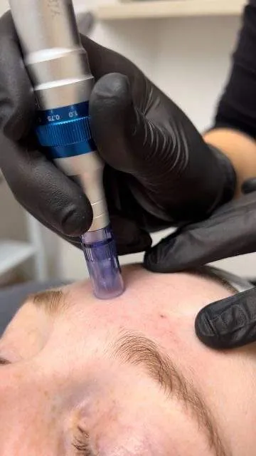 REJUVENECIMIENTO FACIAL  (limpieza facial +dermapen)