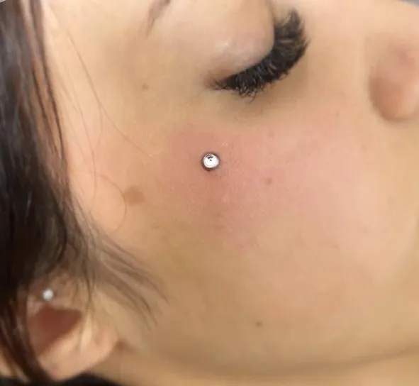 Implante/ microdermal 