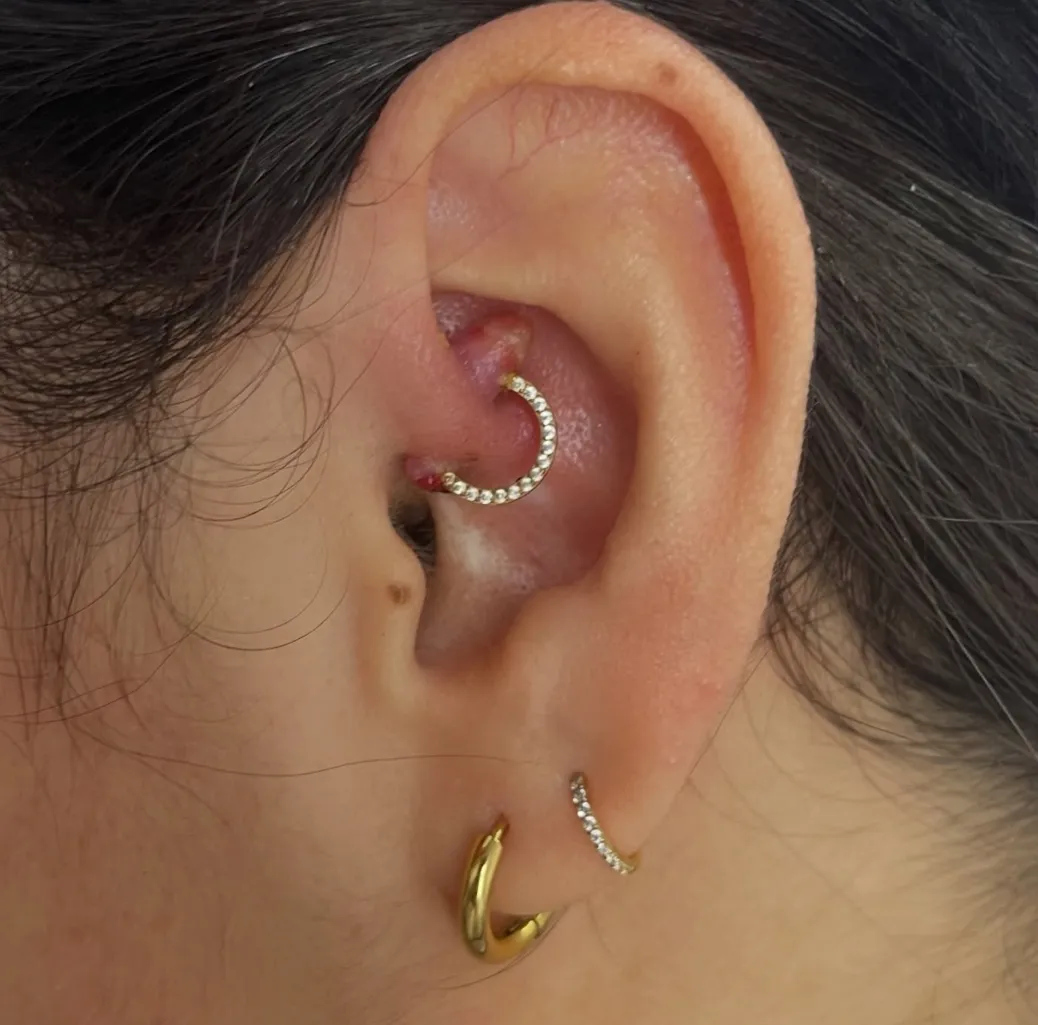 Tratamiento para Granulomas 