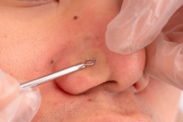 FACIAL  >> Extracción profesional de comedones y miliums