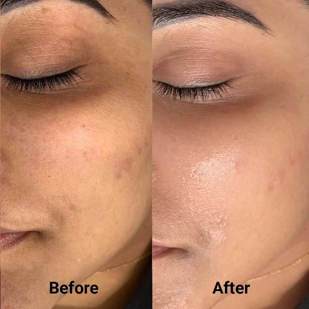 FACIAL  >> BB Glow