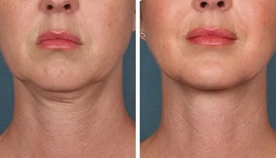 FACIAL  >> HIFU 14D (Lifting sin cirugía)